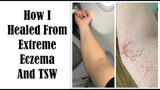 Top 10 Things To Heal From Eczema and TSW  My Journey of Healing [upl. by Ostap853]