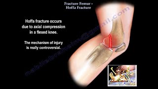 Fracture Femur Hoffa Fracture  Everything You Need To Know  Dr Nabil Ebraheim [upl. by Painter74]