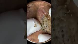 Blackheads Removal on Nose blackheadpimple satisfyingacneshortscravosespinhas removal [upl. by Kitty]