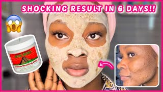 SHOCKING RESULT 😱 6 days of Aztec healing clay mask on my skin  Aztec clay mask for acne [upl. by Nerhtak811]