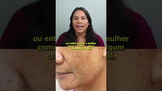 O que é melasma estética melasma mancha [upl. by Assirahs]