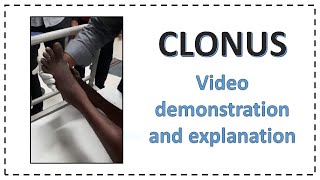 Clonus  Video Demonstration and Full Explanation  In 2 Minutes [upl. by Cohl]