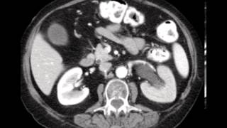 Delayed Nephrogram Stone CASE DISCUSSION by a Radiologist [upl. by Htenek]