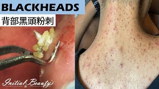 背部黑頭粉刺blackheads on back  Taiwan Tainan台南清粉刺最乾淨 [upl. by Stormie]