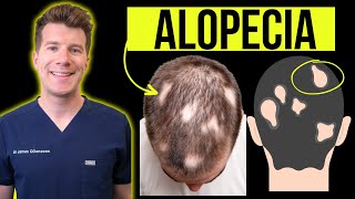 Doctor explains Alopecia Areata aka patchy or total hair loss  Signs Symptoms Treatment amp more [upl. by Magulac]