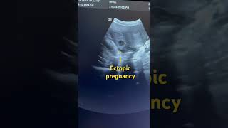 Ectopic pregnancy ectopicpregnancy uterus ultrasound obglife pregnancy ytshortshortbabyyt [upl. by Notwal977]