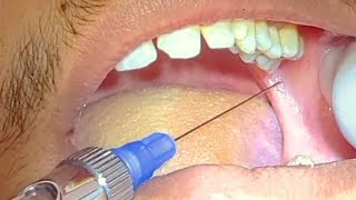 Local Anesthesia  Inferior Alveolar Nerve Block amp infiltration LA techniques طريقة تخدير الاسنان [upl. by Nesmat891]