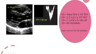 ¿Cómo se calcula el volumen sistólico [upl. by Glori562]