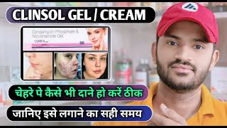 Clinsol gel how to use full review in hindi [upl. by Brubaker]