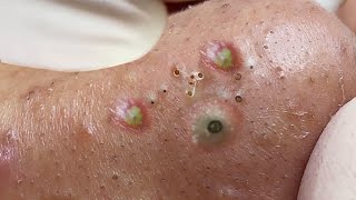 Big Cystic Acne Blackheads Extraction Blackheads amp Milia Whiteheads Removal Pimple Popping  3618 [upl. by Namyw756]