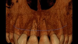 Horizontal Root Fracture Retreatment [upl. by Murrah556]