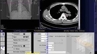 CT Scan angiography of the thoracic aorta SIEMEN  CLVT Động mạch chủ ngực [upl. by Shien]