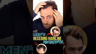 Receding Hairline regrowth derma roller hair mensgrooming [upl. by Dur]