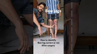 How identify correction of bow legs After surgery bowlegs bowlegsurgery [upl. by Semele]