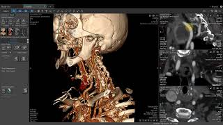 Vitrea Demonstrations  Hounsfield Unit Tools [upl. by Trevlac858]