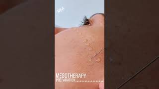 Mesotherapy Facial Treatment Benefits Procedure amp FAQ  EDEN AESTHETICS Dubai [upl. by Khosrow]