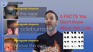 5 Facts About Hair Loss Patterns Was Dr Norwood Wrong [upl. by Prober538]