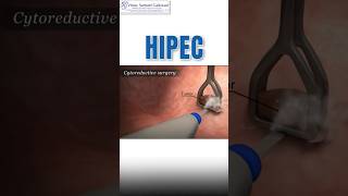 What is HIPEC  Cancer treatment cancertreatment hipec [upl. by Anaicul]