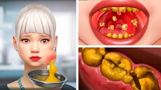 ASMR Dental Cleaning Procedures amp Tonsil Stones Removal Acne on the face  Deep Cleaning Animation [upl. by Alrzc]