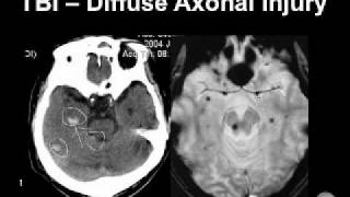 Diagnosing Brain Hemorrhages [upl. by Nolyarb]