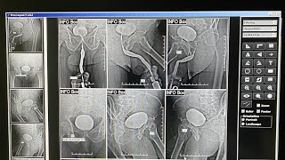 Ascending Cystourethrography اشعه صاعده علي قناه مجري البول [upl. by Anilas]