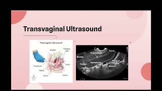 Ultrasound and Saline Infusion Sonography SIS in Diagnosing Leiomyomas amp Endometrial Polyps [upl. by Varipapa]