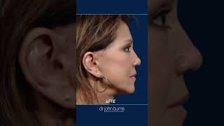 Facelift Before amp After  10 year Facelift Results [upl. by Ytsud]