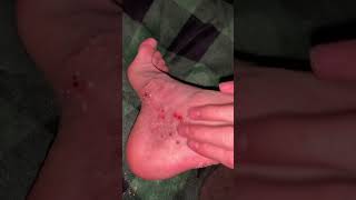 eczema feet scratching asmr worse than last time [upl. by Yadnil]