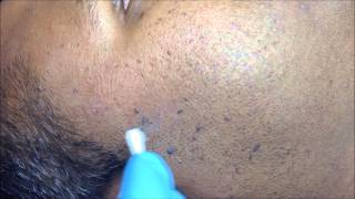 Seborrhoeic Keratosis side of face [upl. by Theron764]