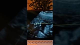 Miracle IVF Pregnancy Success Story ivfvideosinmalayalam ivfvideosforpregnancyinmalayalam [upl. by Bradly]