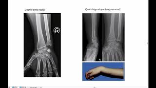 Radiographie du poignet [upl. by Lecirg]