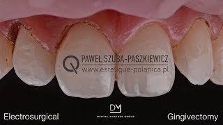 Electrosurgical Gingivectomy  Crown Lengthening [upl. by Neffets]