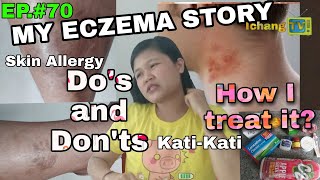 PAANO GAMUTIN ANG ECZEMA SKIN ALLERGY O KATI KATI SA BALAT  causes symptoms and treatment [upl. by Dlarrej]