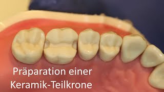 Präparation einer KeramikTeilkrone [upl. by Wilsey]