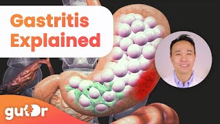 What is Gastritis  The GutDr Explains 3D Gut Animation [upl. by Gusti]