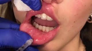 Dissolving Lip Filler by Dr Kassir [upl. by Driskill]