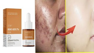 hyperpigmentation serum  daag dhabbe hataye dermatouch serum [upl. by Davon]