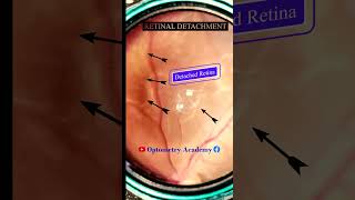 Retinal detachment  Diabetic retinopathy  Fundus  Short Video 135 [upl. by Ilenay]