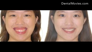 Gummy smile treatment [upl. by Vedette]