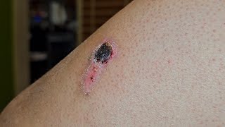 Scab after Burn 🔥 [upl. by Arodasi]