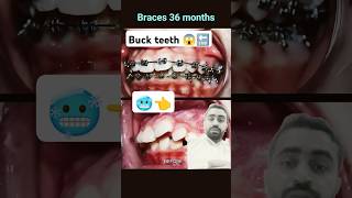 Fix buck and crooked teeth 36 months braces orthodontist braces dentisit [upl. by Aehsrop]