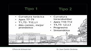 Cifosis de scheurmann [upl. by Euqinomod]