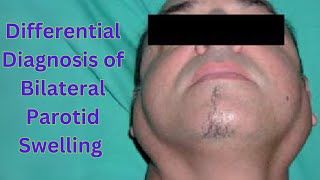 Bilateral Parotid Swelling Differential Diagnosis [upl. by Ades]