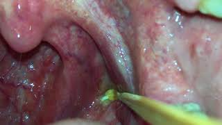 Tonsil Stone Removal By Yourself [upl. by Yessej]