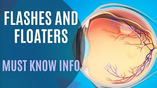 Flashes Floaters Posterior Vitreous Detachment vs Retinal Detachment [upl. by Leahcimdivad478]