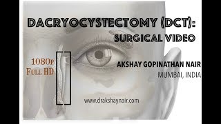 Dacryocystectomy  DCT Lacrimal Mucocele  surgical video Full HD [upl. by Simona]