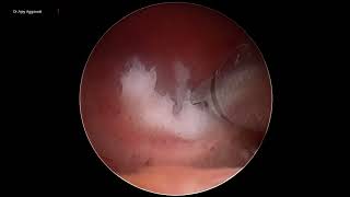 Hysteroscopic myomectomy using TruClear system Hysteroscopic Morcellator [upl. by Orlina]