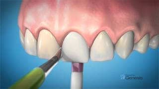 Keystone Dental Genesis Implant System [upl. by Anaeerb]