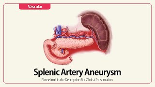 Splenic Artery Aneurysm [upl. by Niltag]