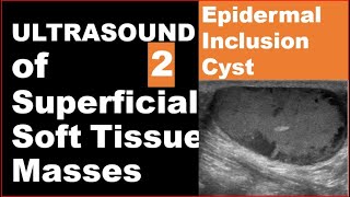 Epidermoid inclusion cyst on Ultrasound [upl. by Stenger585]